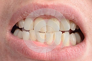 A young woman shows her crooked teeth that needs medical help in close-ups