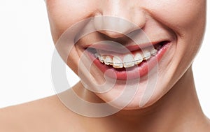 Dental braces