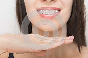 Young woman smile with dental braces. Brackets on the teeth after whitening. Self-ligating brackets with metal ties and gray