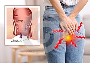 Young woman suffering from hemorrhoid pain, closeup. Illustration of unhealthy lower rectum