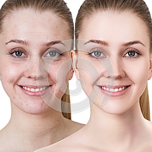 Young woman before and after treatment and make-up.