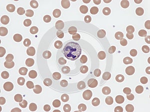 Z-neutrophil in peripheral blood. photo