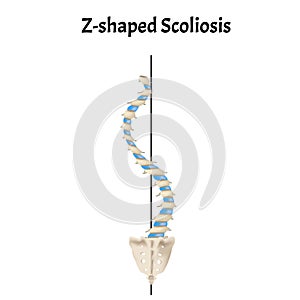 Z-shaped scoliosis. Dextroscoliosis. Levoscoliosis. Spinal curvature, kyphosis, lordosis, scoliosis, arthrosis