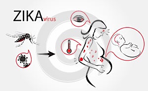 Zika virus fever