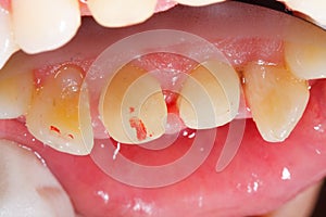 Zirconia basis probation photo