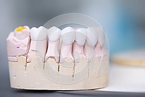 Zirconia dentures on a gypsum jaw - Ceramic dentures - photo