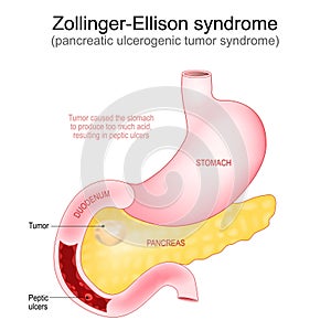 Zollinger-Ellison syndrome. Gastrinoma photo