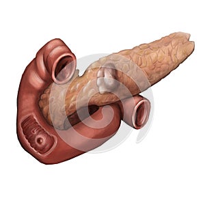 Zollinger Ellison syndrome. Illustration of the pancreatic cancer and duodenal ulcer photo