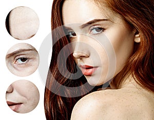 Zoom circle shows of aged skin of redhead woman before and after rejuvenation.