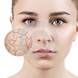 Zoom circle shows dry facial skin before moistening.