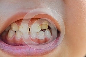 A zoomed-in image captures the mouths of children with misaligned, fractured teeth and odontolith