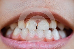 A zoomed-in image captures the mouths of children with misaligned, fractured teeth and odontolith