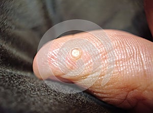 Zoomed-in View: The Intricacies of a Distinct Thumb Wart