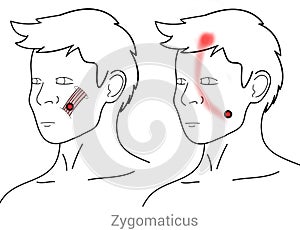 Zygomaticus: managing pain arriving from myofascial trigger points in the face