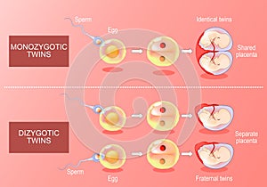 Zygote developments in monozygotic and dizygotic twins photo