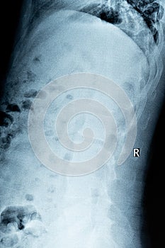 è…°æ¤Žè½»åº¦éª¨è´¨å¢žç”Ÿçš„Xå…‰ç‰‡X-rays of lumbar mild hyperosteogeny