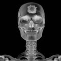 3D Radiograph with head injury Royalty Free Stock Photo