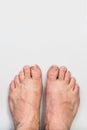 Abandoned fingers on legs, dirty, uncut and broken nails, top view, gray background, health and care Royalty Free Stock Photo