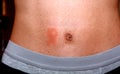 Pityriasis Rosea. Herpes. Red spots on the skin. Allergy. Weak immunity