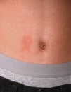 Pityriasis Rosea. Herpes. Red spots on the skin. Allergy. Weak immunity