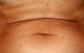 The abdomen is in red angiomas. Flabby wrinkled abdomen. The navel is stretched.