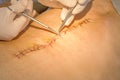 Abdomen scar after surgery