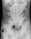 Abdomen showing DJ stent in right ureter.medical image