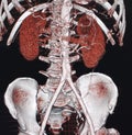 ABDOMINAL AORTIC ANEURYSM, CT