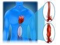 Abdominal aortic aneurysm