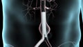 Abdominal Aortic Aneurysm Repair