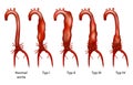 Abdominal aortic aneurysm Royalty Free Stock Photo