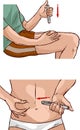 Abdominal and leg insulin injection illustration