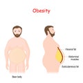 Abdominal obesity. Visceral and subcutaneous fat Royalty Free Stock Photo