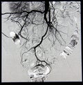 Abdominal and pelvic angiography, vessels