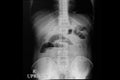 abdominal xray film of a patient with small bowel obstruction