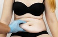 Abdominoplasty and torsoplasty: abdominal liposuction and removal of the apron. The patient at the reception at the plastic