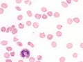 Babesiosis in peripheral blood. Royalty Free Stock Photo