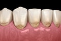 Abfraction of anterior teeth. Medically accurate 3D illustration