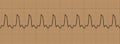 Abnormal cardiogram ventricular tachycardia