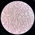 Abnormal cell macro ovalocyte