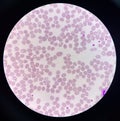 Abnormal cell macro ovalocyte