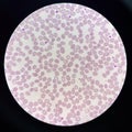 Abnormal cell macro ovalocyte