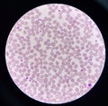 Abnormal cell macro ovalocyte