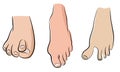 Abnormal feet