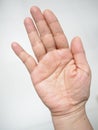 Abnormal finger alignment due to accident