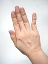 Abnormal finger alignment due to accident