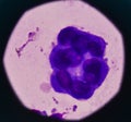 Abnormal malignant cells specimen pleural fluid.