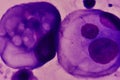 Abnormal malignant cells specimen pleural fluid.