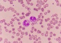 Abnormal neutrophil in blood smear.