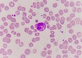 Abnormal neutrophil in blood smear.